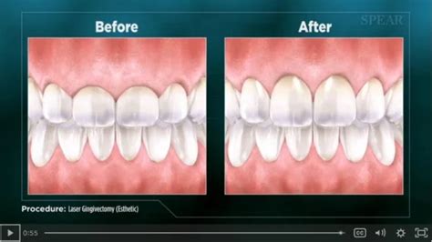 Laser Dentistry In Summerlin, Las Vegas .